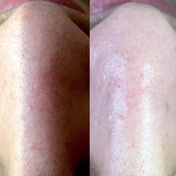 Механическая чистка лица + сыворотка + альгинатная маска
                    Косметолог Валерия Одеса