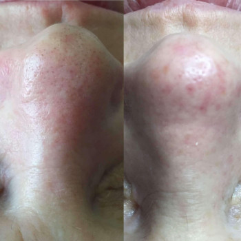 Механическая чистка лица + сыворотка + альгинатная маска
                    Косметолог Валерия Одеса