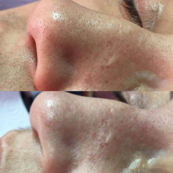 Механическая чистка лица + зона декольте
                    Косметолог Валерия Одеса