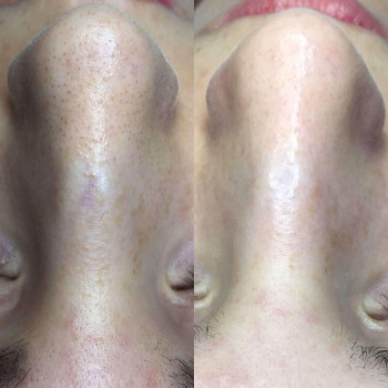 Механическая чистка лица + зона декольте
                    Косметолог Валерия Одеса