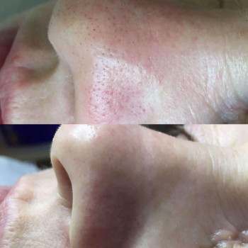 Механическая чистка лица + зона декольте
                    Косметолог Валерия Одеса