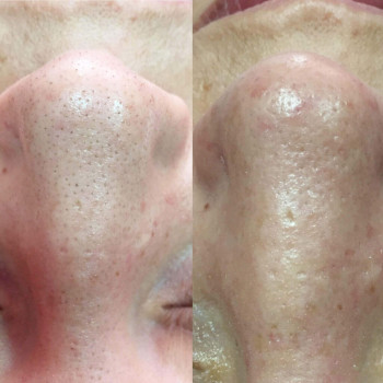 Комбинированная чистка лица + сыворотка + альгинатная маска
                    Косметолог Валерия Одеса