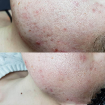 Пилинг миндальный SIMILDIET
                    Косметолог Валерия Одеса