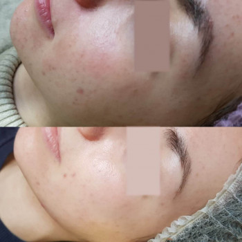 Пилинг миндальный SIMILDIET
                    Косметолог Валерия Одеса