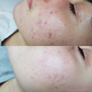 Пилинг миндальный SIMILDIET
                    Косметолог Валерия Одеса