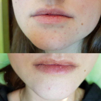 Пилинг миндальный SIMILDIET
                    Косметолог Валерия Одеса