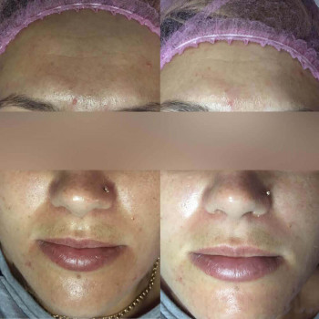 Пилинг миндальный SIMILDIET
                    Косметолог Валерия Одеса