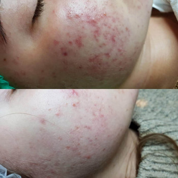 Пилинг азелаиновый SIMILDIET
                    Косметолог Валерия Одеса