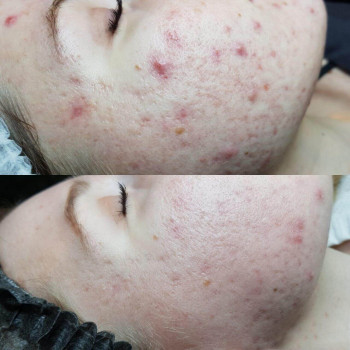 Фитопилинг
                    Косметолог Валерия Одесса