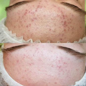 Фитопилинг
                    Косметолог Валерия Одесса