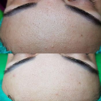 Пилинг Кемикум
                    Косметолог Валерия Одеса