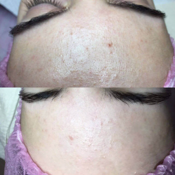 Пилинг Кемикум
                    Косметолог Валерия Одеса