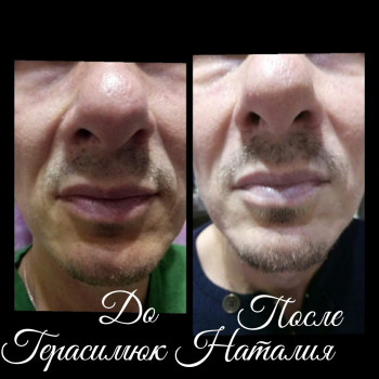 контурная пластика носогубной складки