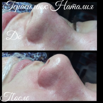 чистка лица