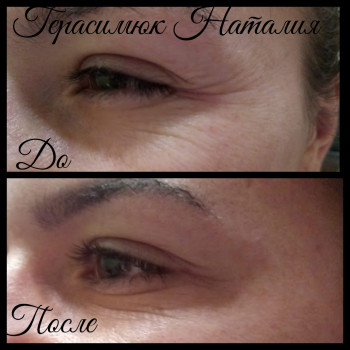 ботокс глаз