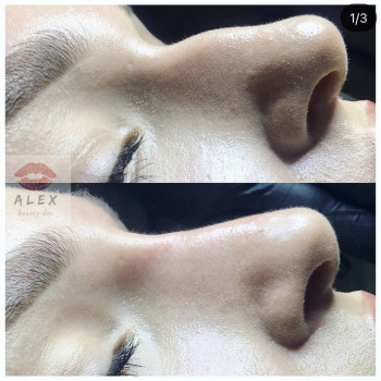 Ринопластика безоперационная
                    Косметолог-инъекционист Алекс Черкассы
