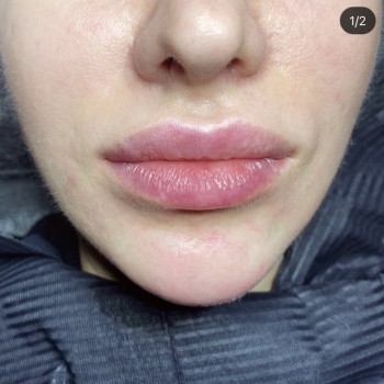 Збільшення губ
                    Косметолог-инъекционист Алекс Черкассы