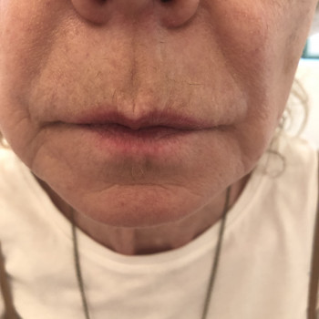 Контурна пластика обличчя