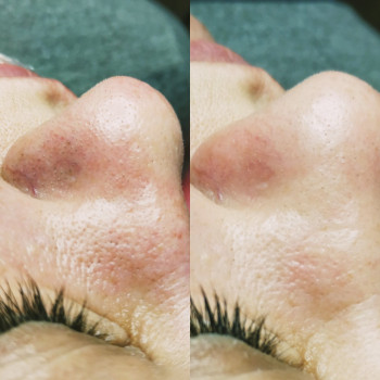 Чистка обличчя