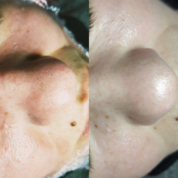 Чистка обличчя