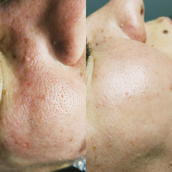 Чистка обличчя