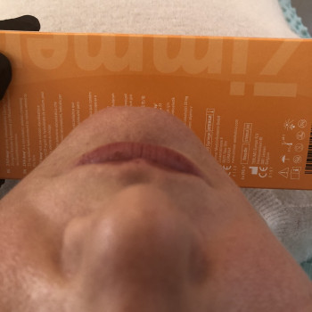 Мезотерапія