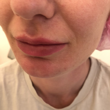 Мезотерапія