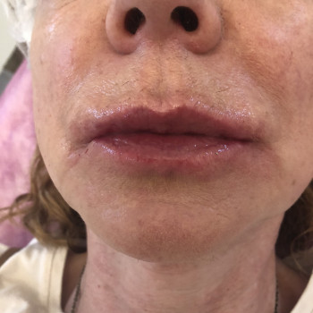 Мезотерапія