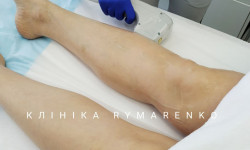 Безопасная лазерная эпиляция Косметологічний центр Rymarenko Clinic Київ