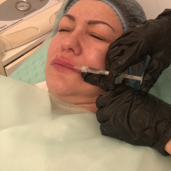 Мезотерапія
                    Косметолог-ін'єкціоніст Надія Львів