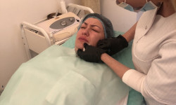 Биоревитализация лица гиалуроновой кислотой (биологическая ревитализация) Косметолог-инъекционист Надія Львов