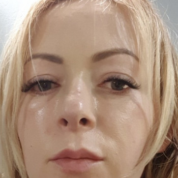 Биоревитализация лица гиалуроновой кислотой (биологическая ревитализация)
                    Косметолог-инъекционист Надія Львов