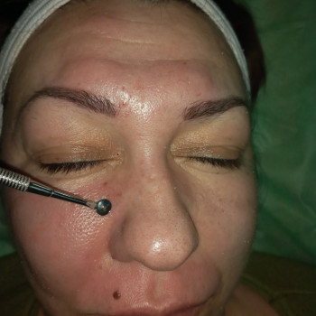 Чистка обличчя механічна
                    Косметолог-инъекционист Надія Львов