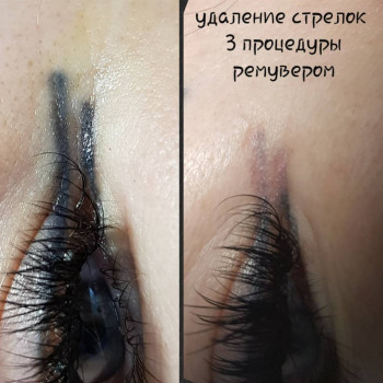 Удаление татуажа стрелок