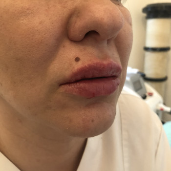 Корекція губ
                    Косметолог-инъекционист Надія Львов