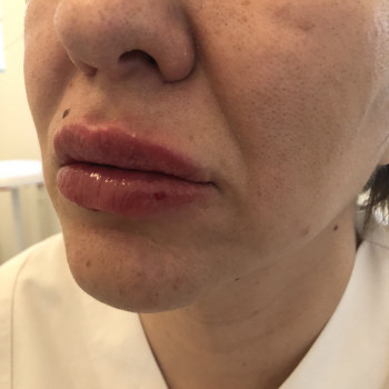 Мезотерапія
                    Косметолог-ін'єкціоніст Надія Львів