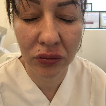 Мезотерапія
                    Косметолог-ін'єкціоніст Надія Львів