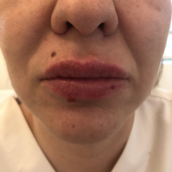 Биоревитализация лица гиалуроновой кислотой (биологическая ревитализация)
                    Косметолог-инъекционист Надія Львов