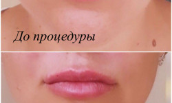 Увеличение губ филлером Косметолог Ирина Киев