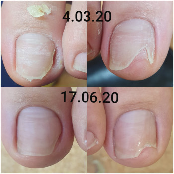 Онихолизис ногтя, динамика