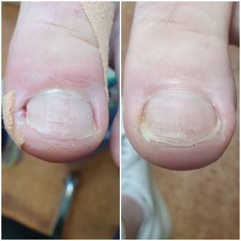 Вросший ноготь, динамика