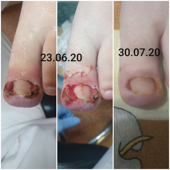 Вросший ноготь, динамика