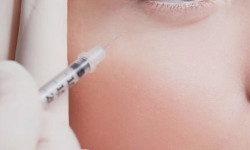 Мезотерапія обличчя Косметологический центр N.A.M. esthetic Киев