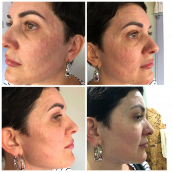 Фото з портфоліо косметолога Алла Рогожа (Дніпро)