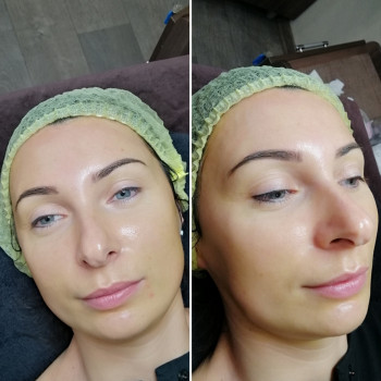 Химический пилинг
                    Косметолог-эстетист Влада Харьков