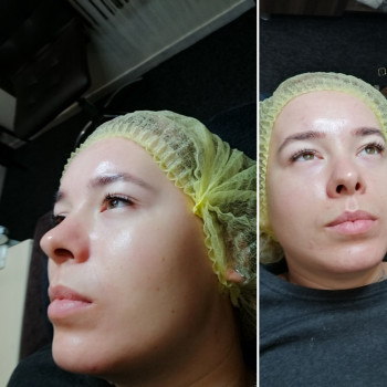 Химический пилинг
                    Косметолог-эстетист Влада Харьков