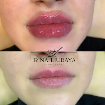 Контурная пластика губ