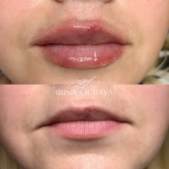 Контурная пластика губ