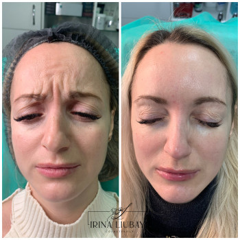 Ботулинотерапия