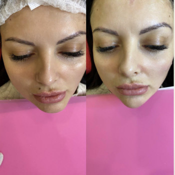 Коррекция асимметрии подбородка , 1ml препарата